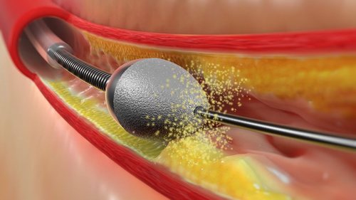 Ilustração de aterectomia rotacional em placa calcificada