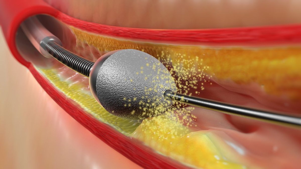 Aterectomia rotacional - Dr. Luiz Benittez, cardiologista intervencionista em Rondônia
