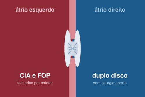 Esquema de prótese de duplo disco fechando a comunicação interatrial