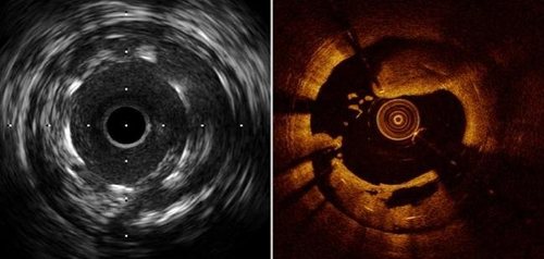 Imagem de IVUS e de OCT da artéria coronária em corte transversal