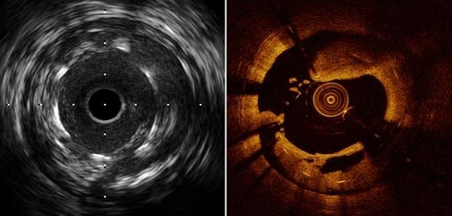 IVUS e OCT: a artéria por dentro - Dr. Luiz Benittez, cardiologista intervencionista em Rondônia