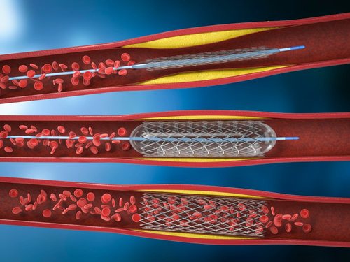 Ilustração das etapas da angioplastia com implante de stent