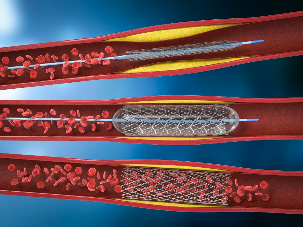 Como o stent abre a artéria - Dr. Luiz Benittez, cardiologista intervencionista em Rondônia